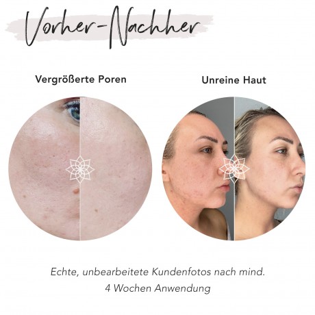 FACES OF FEY Microneedlingset Basic Niacinamid 0,50mm Набор для микронидлинга Basic Niacinamide 0,50 мм