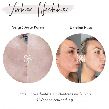 FACES OF FEY Microneedlingset Basic Niacinamid 0,25mm  Набор для микронидлинга Basic Niacinamide 0,25 мм