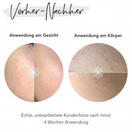 FACES OF FEY Microneedlingset Basic  Hyaluron 0,5mm  Набор для микронидлинга Basic Hyaluron 0,5 мм