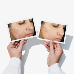 MURAD Invisiscar Resurfacing Treatment  Процедура омоложения Invisiscar